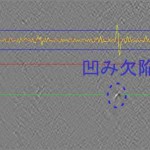 処理画像_凹み(噛み込み)